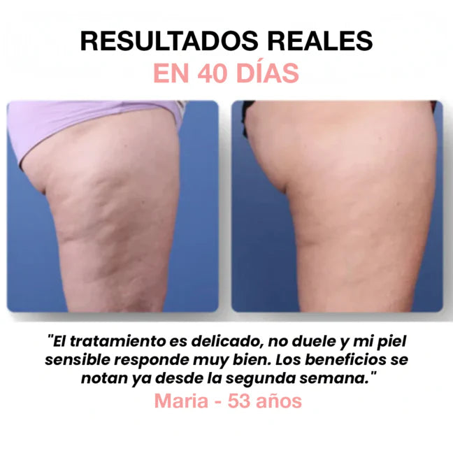 Velure™ - Tu aliado contra la celulitis